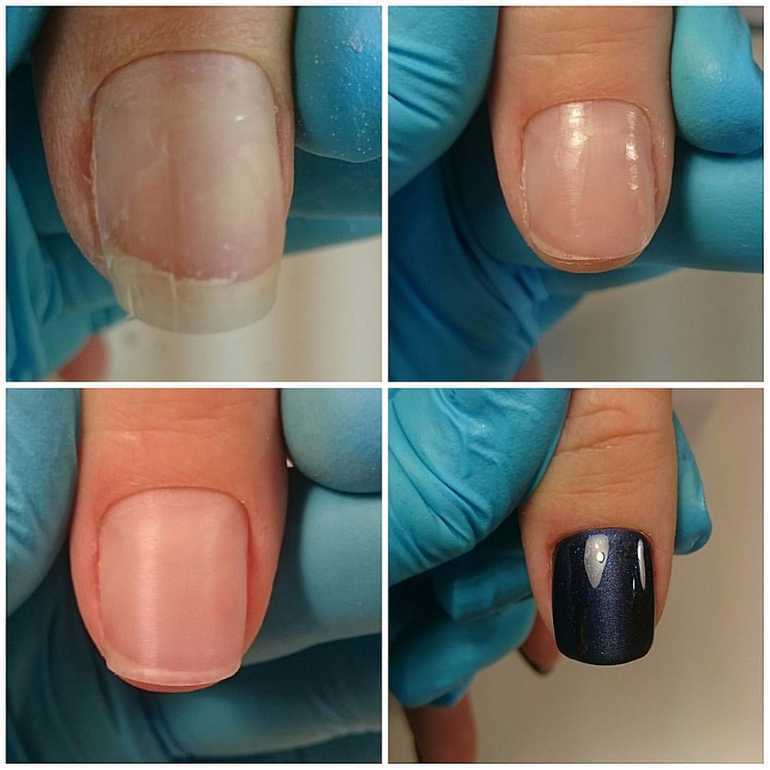 Почему гель-лак плохо держится на ногтях, как это предотвратить?