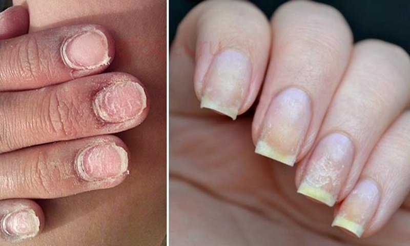 Как восстановить ногти после наращивания в домашних условиях