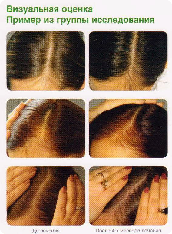 Почему сильно выпадают волосы причины. Пробор волос у женщин при выпадении. Норма выпадения волос. Сильное облысение у женщин.