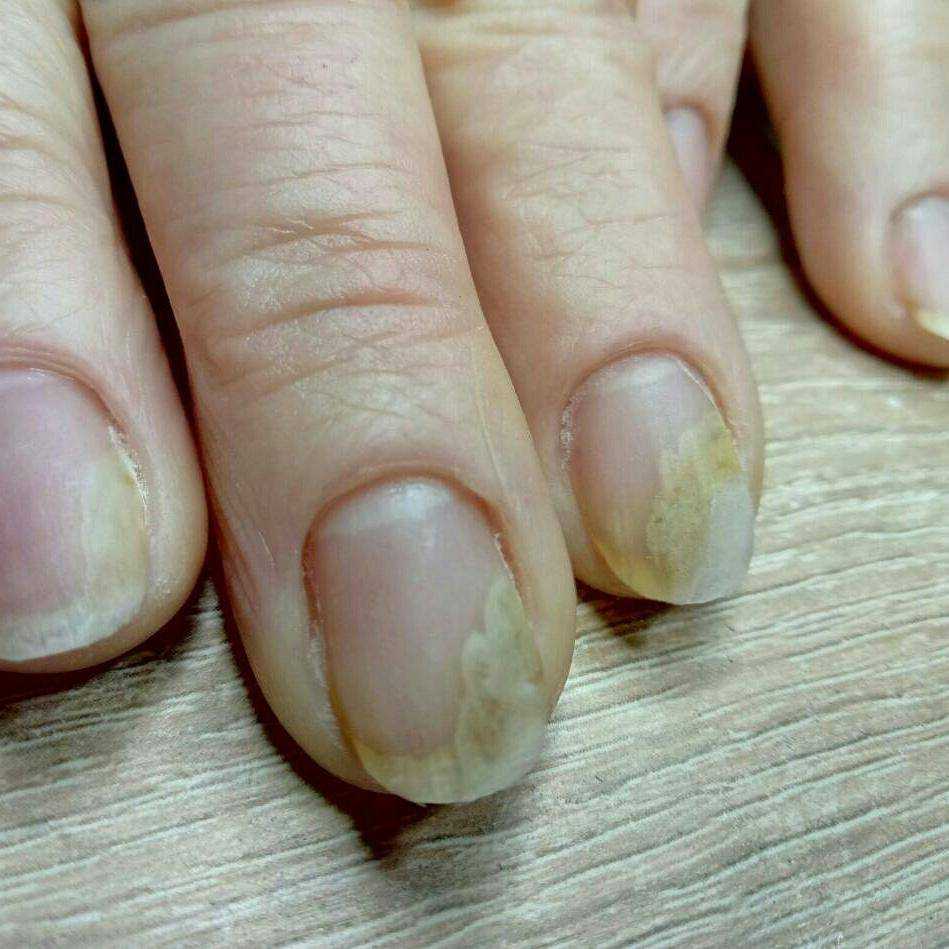 Как восстановить ногти после наращивания: салонные процедуры и домашний уход