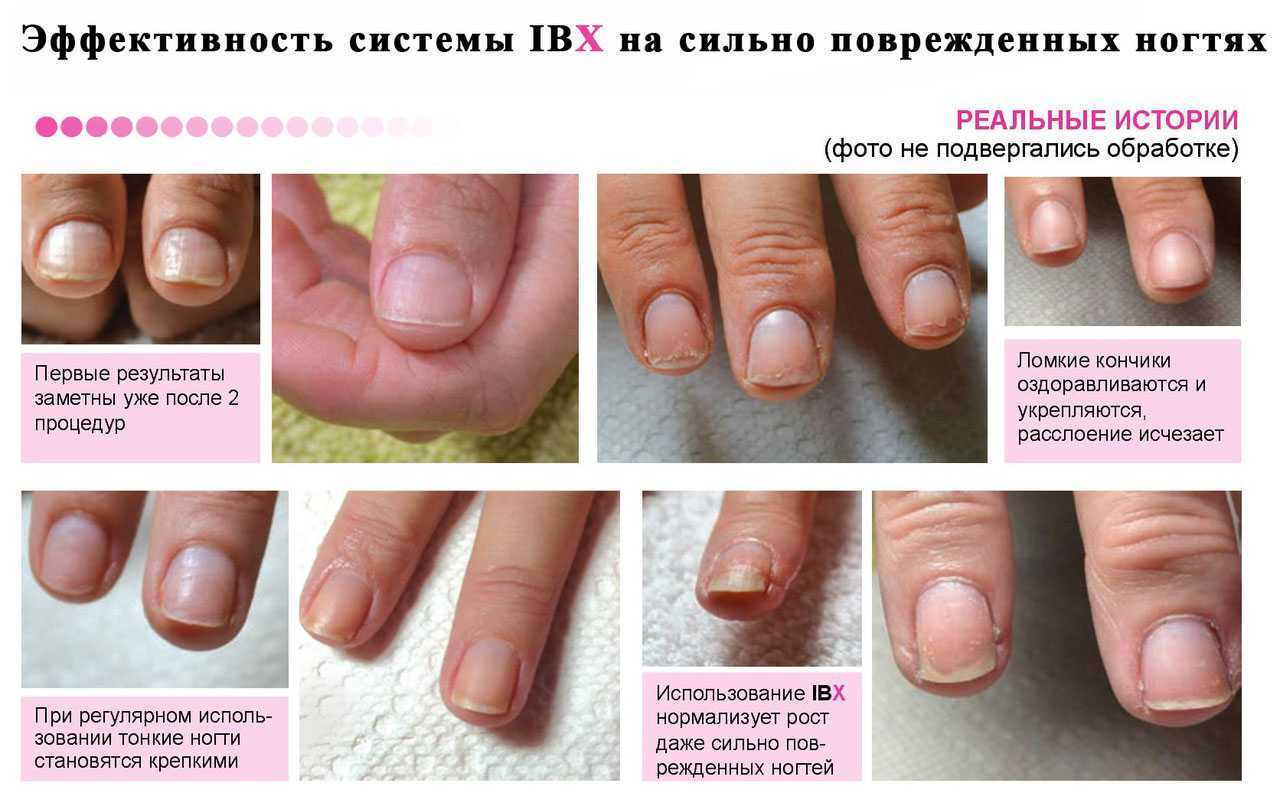 Как восстановить ногти после наращивания?!