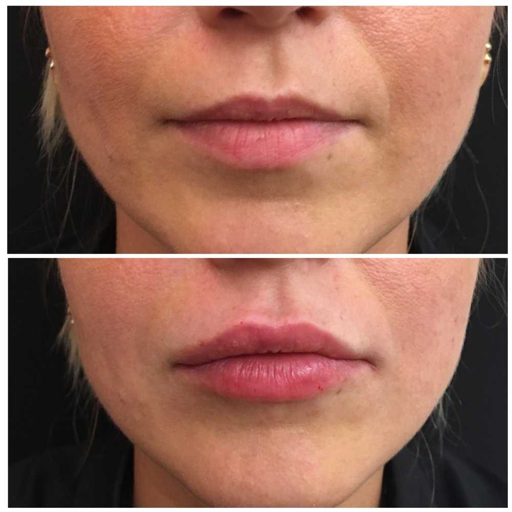 Фото тонких губ после увеличения
