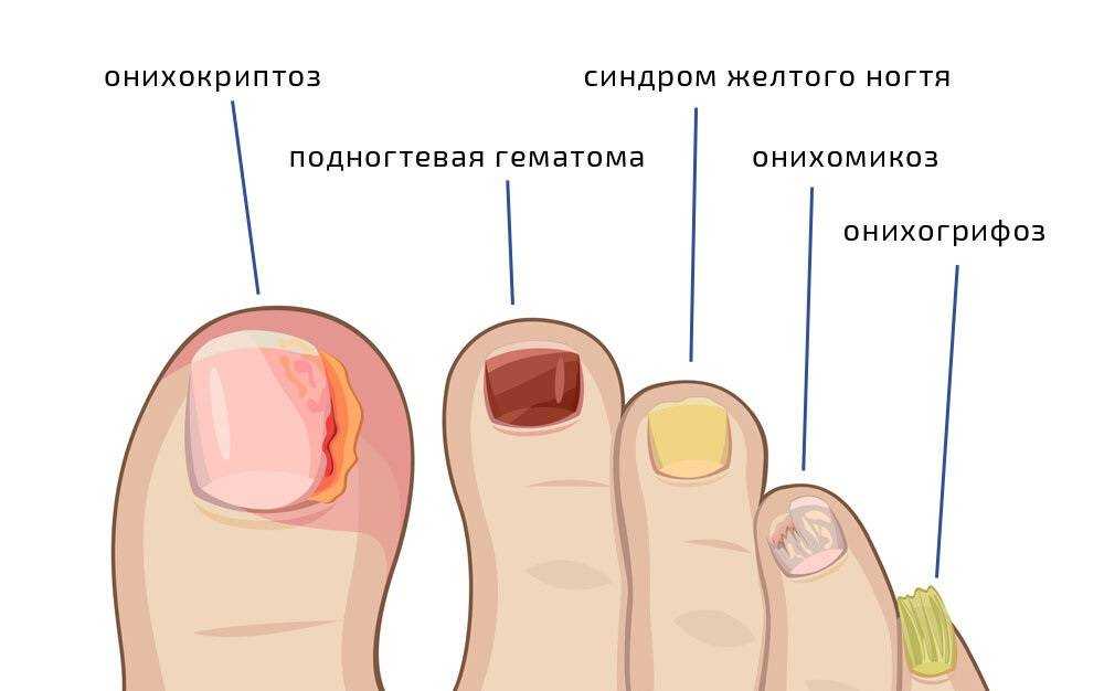 Онихомикоз ногтей схема лечения что это такое у женщин