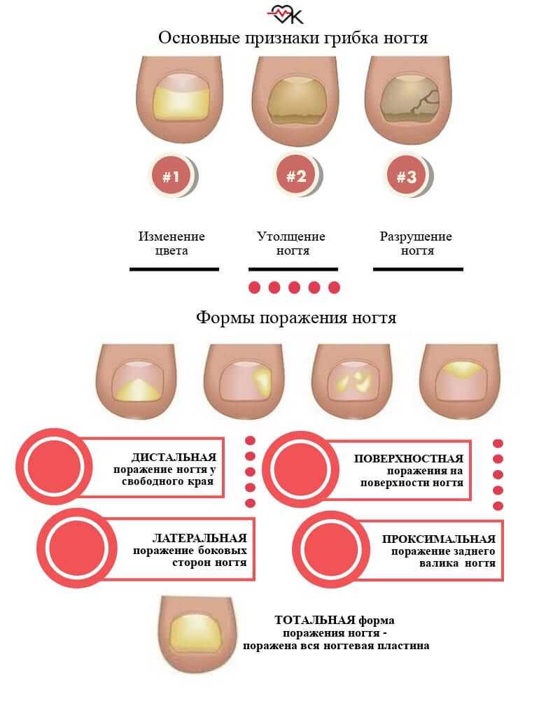 Грибковые инфекции ногтей онихомикоз