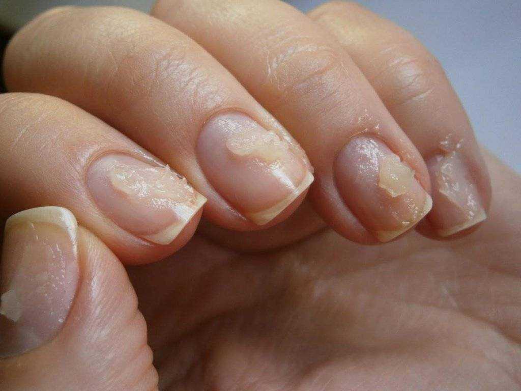 10 лучших способов восстановить ногти после наращивания