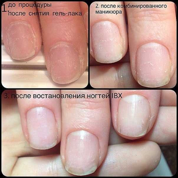 Как восстановить ногти после наращивания гелем и акрилом