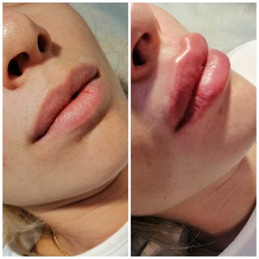 Фото губы после ботокса фото до и после