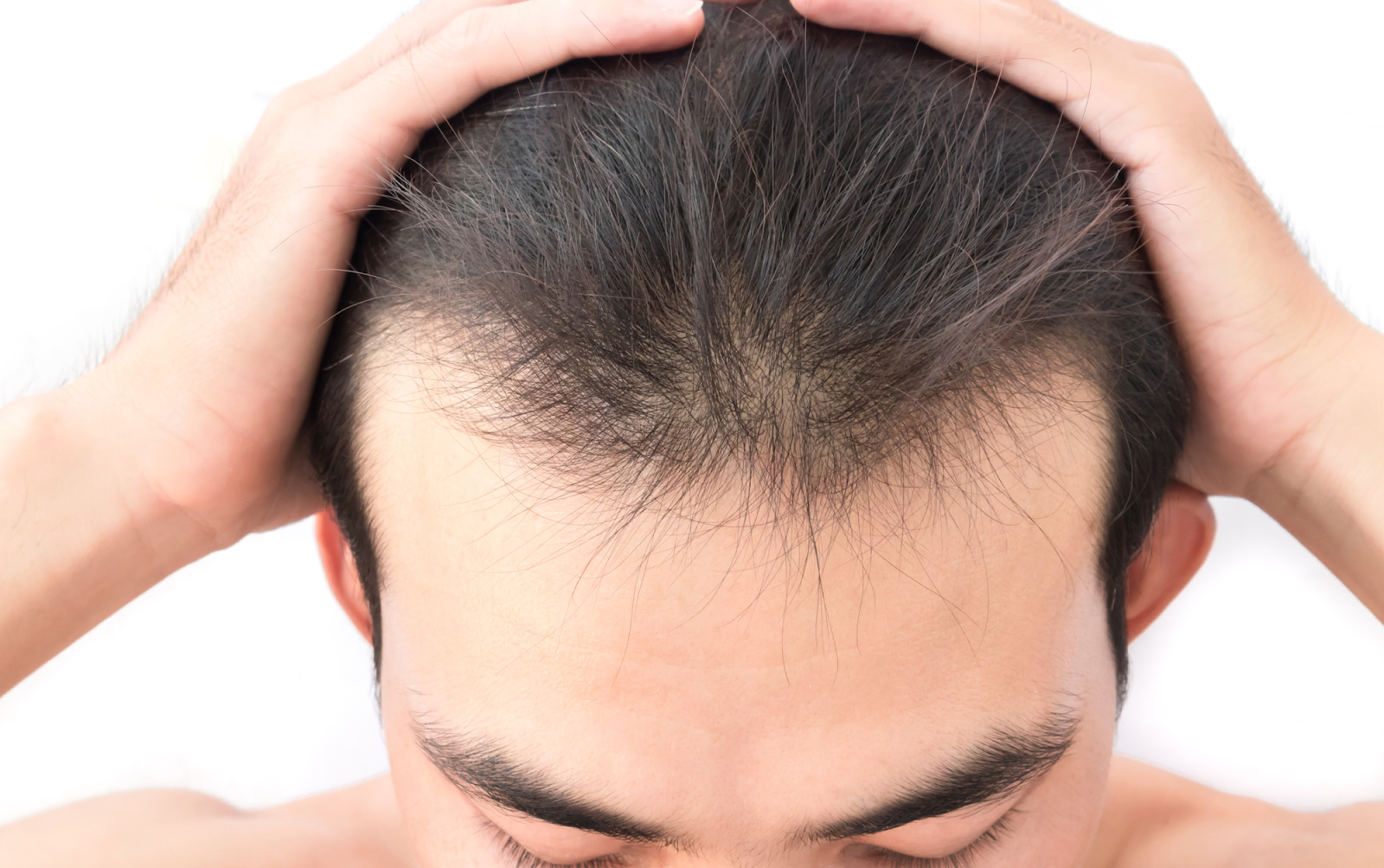 Выпадение волос может быть симптомом вич