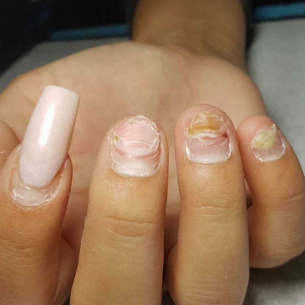 Как восстановить ногти после наращивания. основные способы