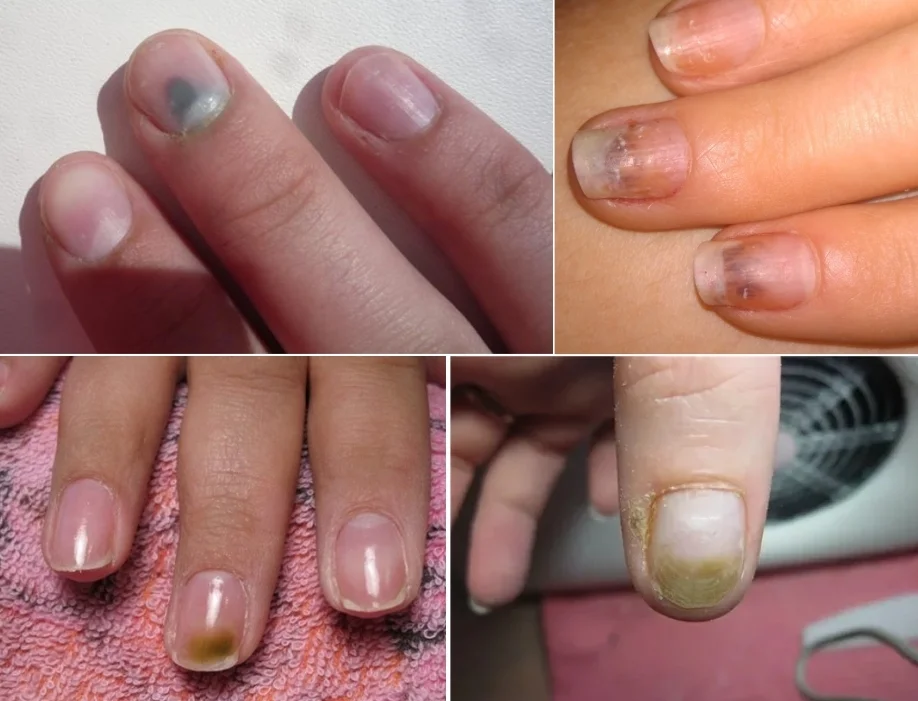 Почему гель-лак не держится на ногтях и кончиках ногтей – причины