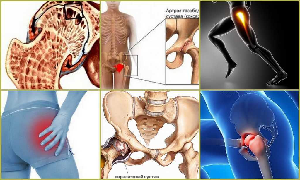Артроз тазобедренного сустава (коксартроз) - симптомы и лечение