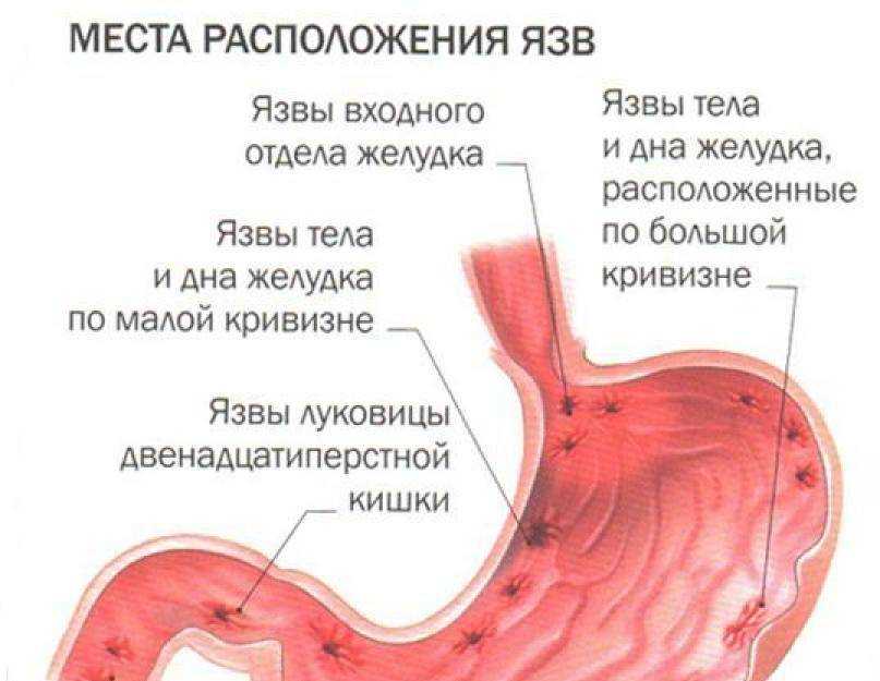 Dietoterapia ulcera gastrica