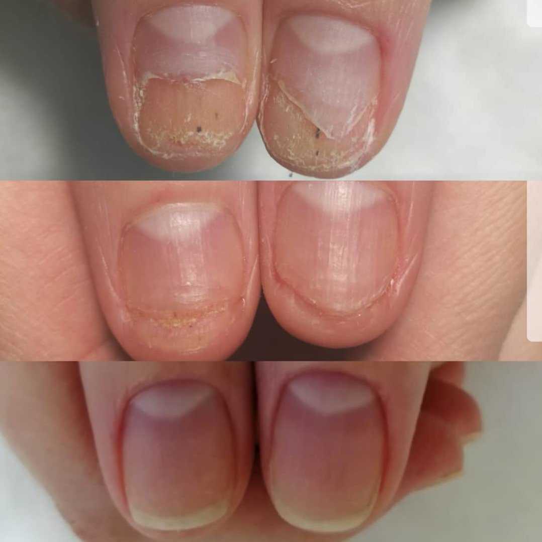Методы восстановления ногтей после наращивания