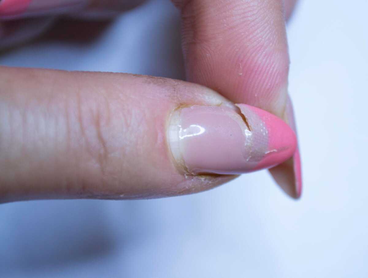 Почему трескается гель-лак на ногтях: от чего трещина через неделю, лопается матовый топ, как спасти, если треснул