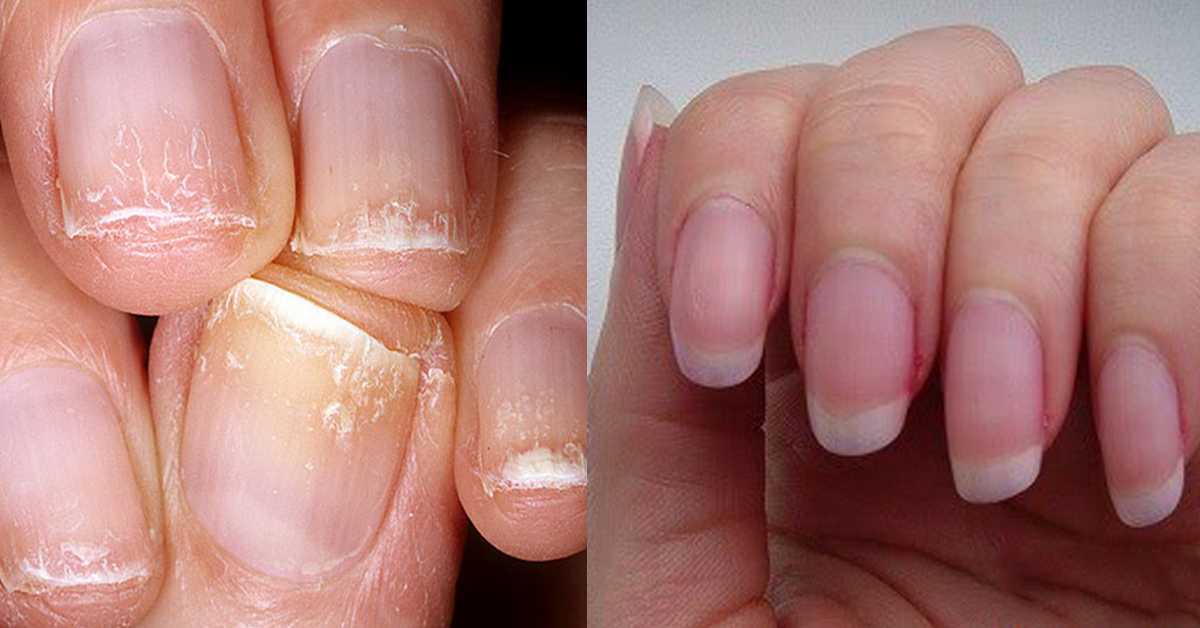 Как восстановить ногти после наращивания гелем: советы эксперта!