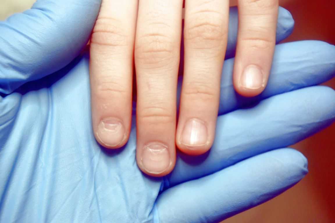 Уход за ногтями в пожилом возрасте. заболевания ногтей у пожилых и престарелых людей